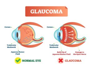 glaucoma adedejiofakure......