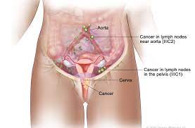cervical canceradedejiofakure