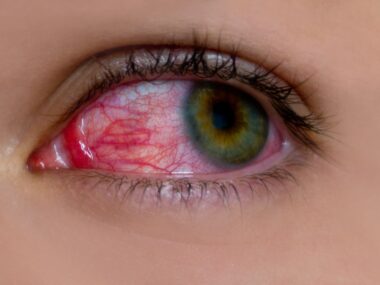 conjunctivitis--adedejiofakure