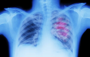 lung canceradedejiofakure
