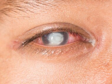 Eye ulcer