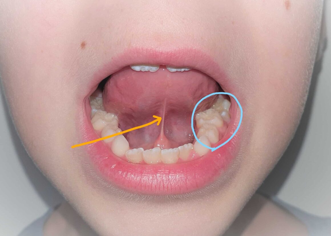 Diagnosis of Tongue Tie Exploring Methods and Procedures Used by