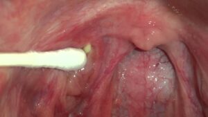 Tonsil stones can cause unhealthy breath