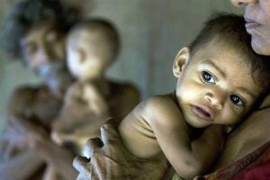 Malnutrition in children