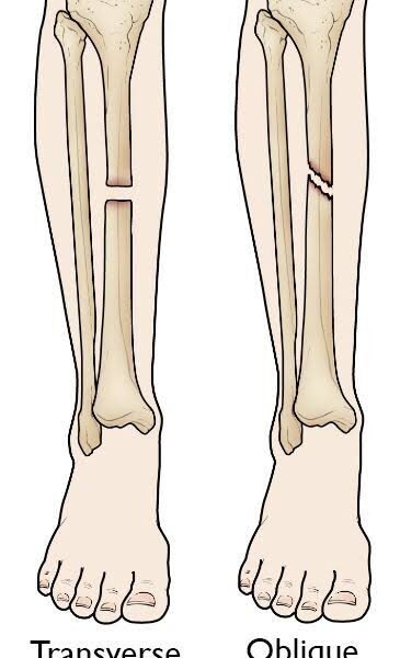 Transverse and Oblique Fractures