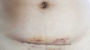Caesarian section scar