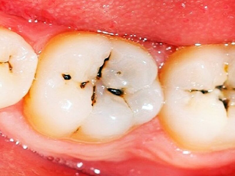 Dental cavities