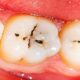 Dental cavities