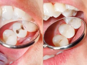 Dental fillings